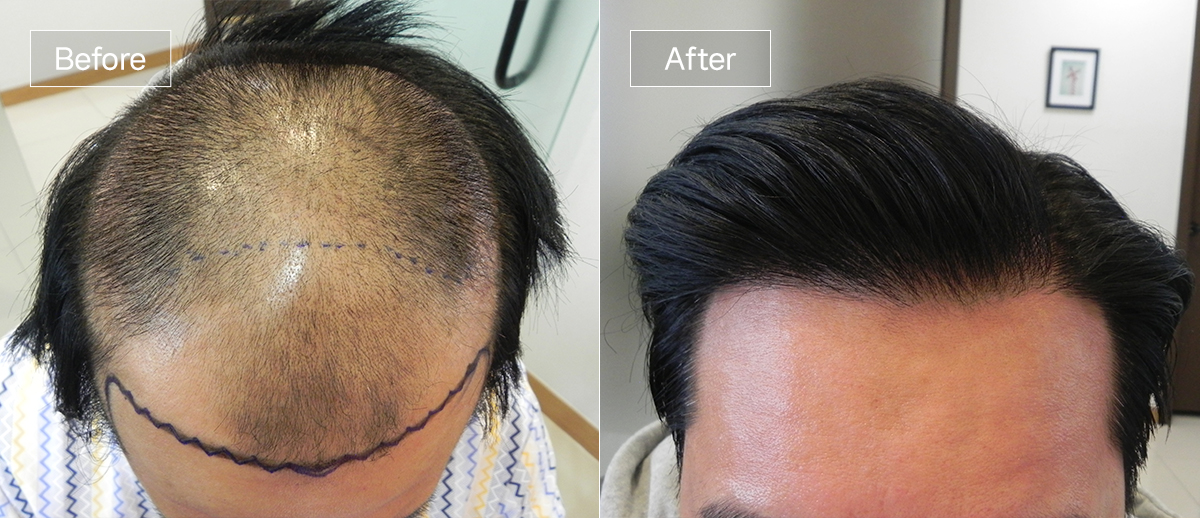 /filedata/md_board/20251229125829_HPAWbcni_sub1_slide4.jpg 전후사진