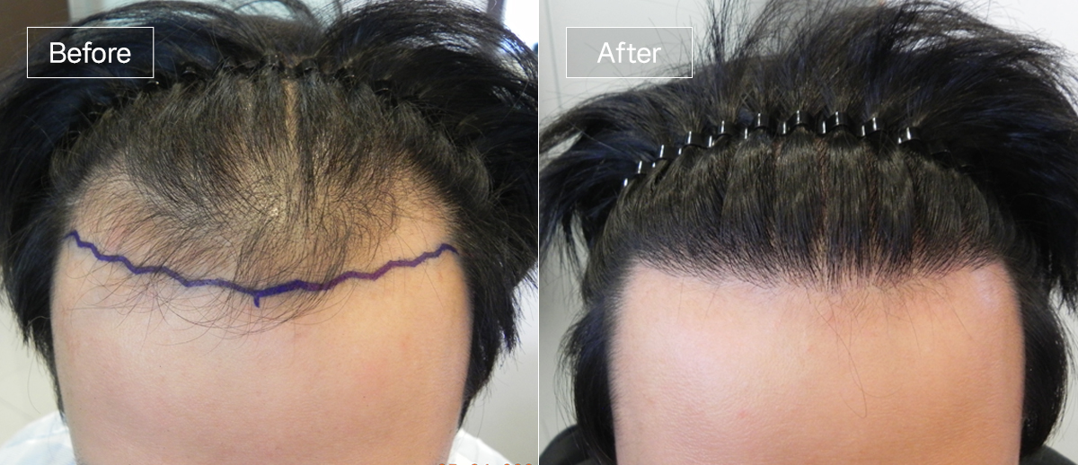 /filedata/md_board/20251229125847_Qyub7ZpT_sub1_slide6.jpg 전후사진