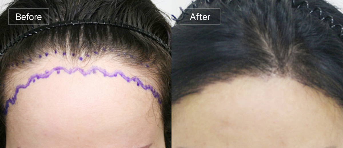 /filedata/md_board/20260102171904_eDv9MsSy_sub3_slide1.jpg 전후사진