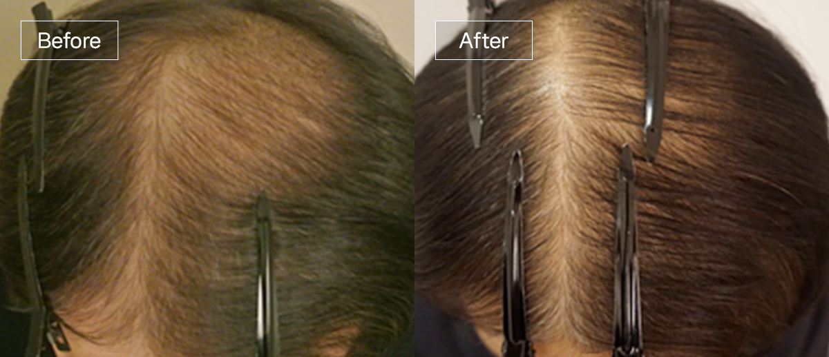 /filedata/md_board/20260102172220_32stRdLM_sub4_slide5.jpg 전후사진